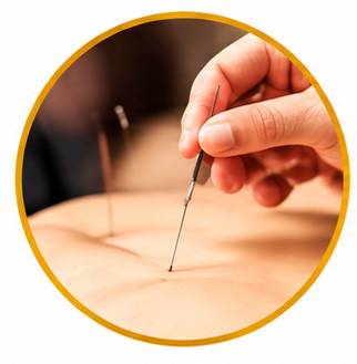 Acupuncture